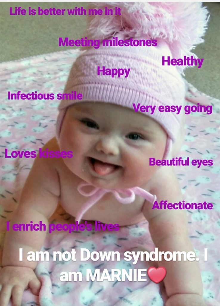 picture of baby with down syndrome who ius sticking her tongue out